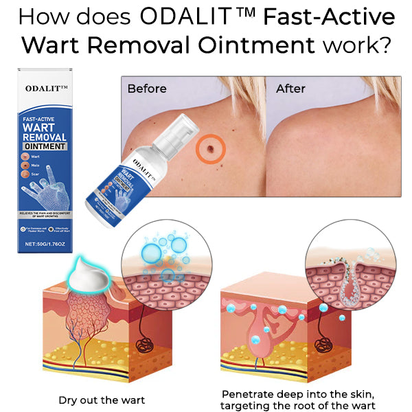 ODALIT⢠Fast-Active Wart Removal Ointment