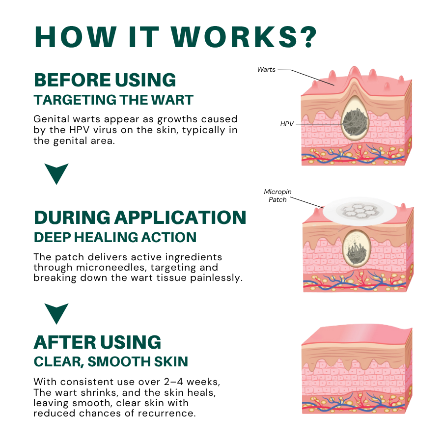 ODALIT™ Genital Wart Removal Patch – Now 40% OFF | Pain-Free, Clinically Proven Solution