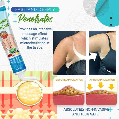 LumpFree Lipoma Removal Cream
