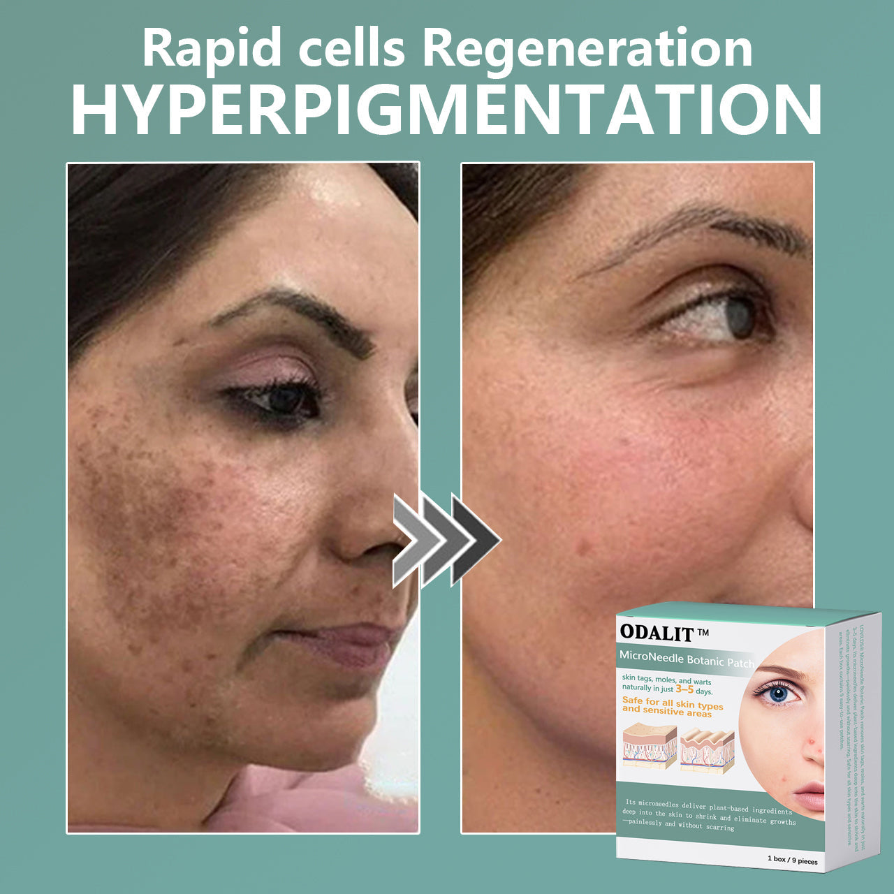 ✨ODALIT™ MicroNeedle Botanic skin Tag Removal Patch