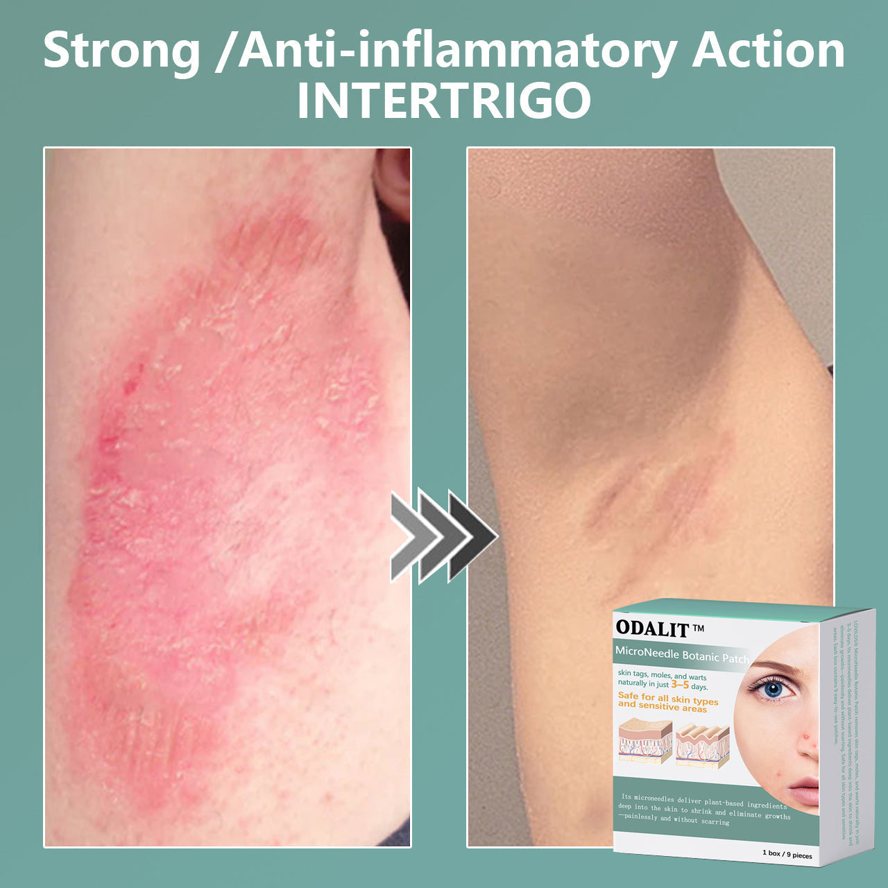 ✨ODALIT™ MicroNeedle Botanic skin Tag Removal Patch