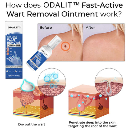 ODALIT™ Fast-Active Wart Removal Ointment