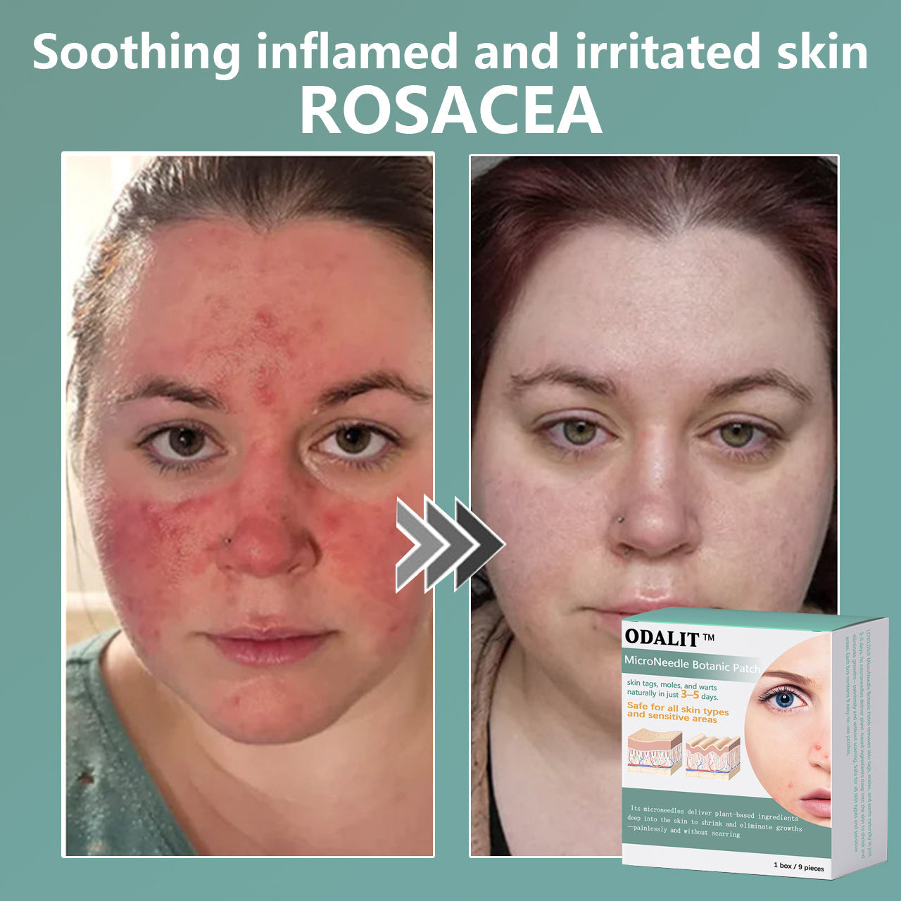 ✨ODALIT™ MicroNeedle Botanic skin Tag Removal Patch