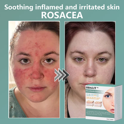 ✨ODALIT™ MicroNeedle Botanic skin Tag Removal Patch