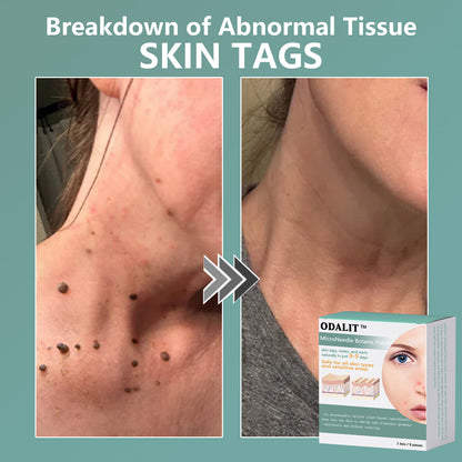 ✨ODALIT™ MicroNeedle Botanic skin Tag Removal Patch