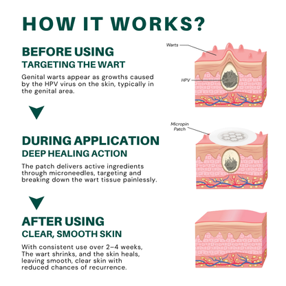 ODALIT™ Genital Wart Removal Patch – Now 40% OFF | Pain-Free, Clinically Proven Solution